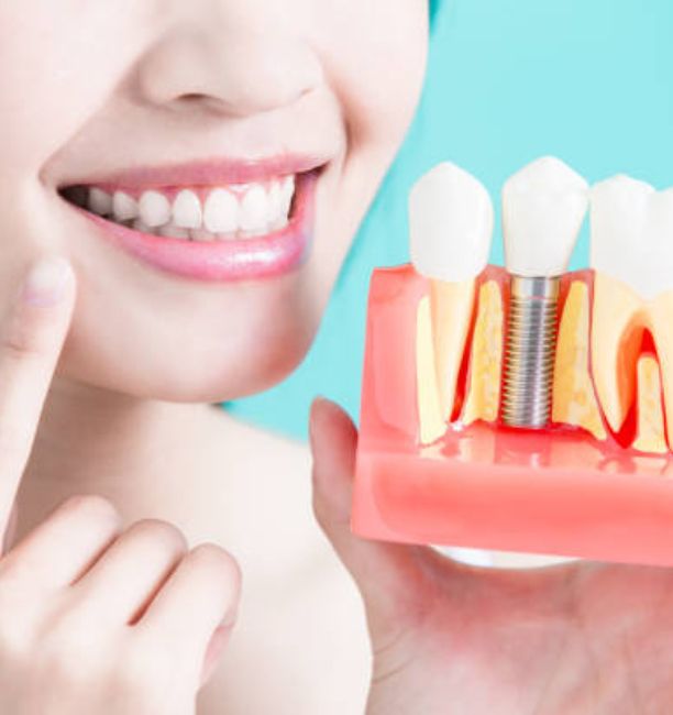dental implant model