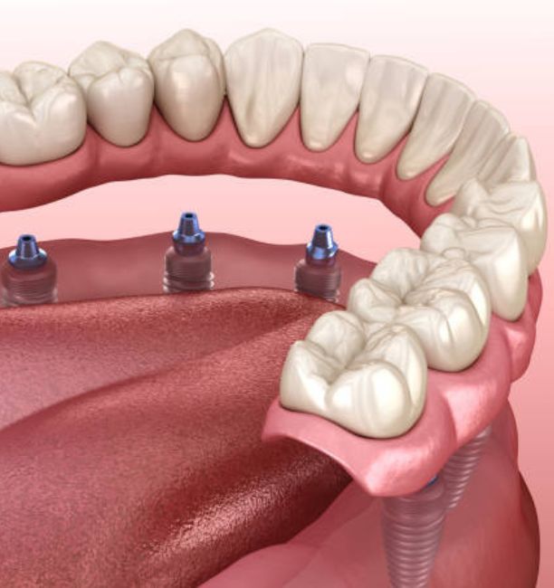 dentures in upper jaw