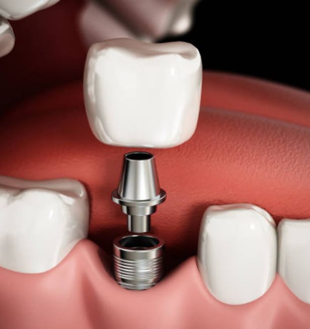 Single tooth dental implant illustration