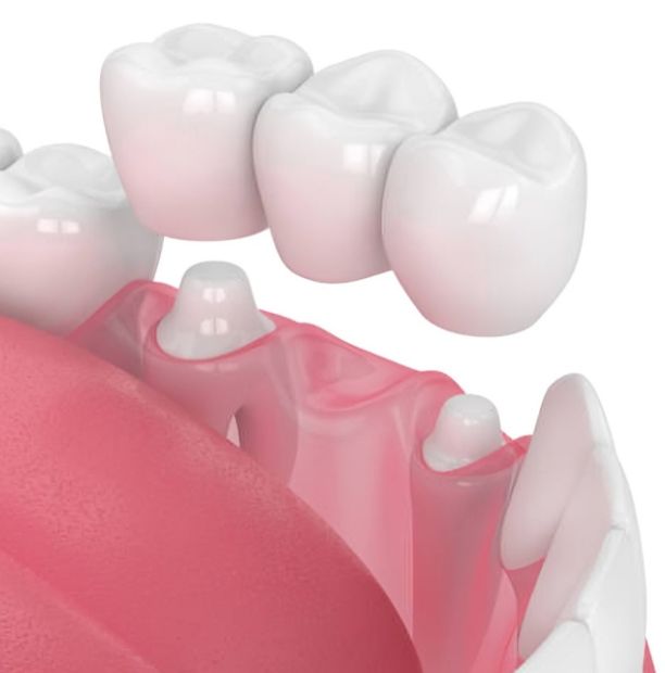 dental bridges