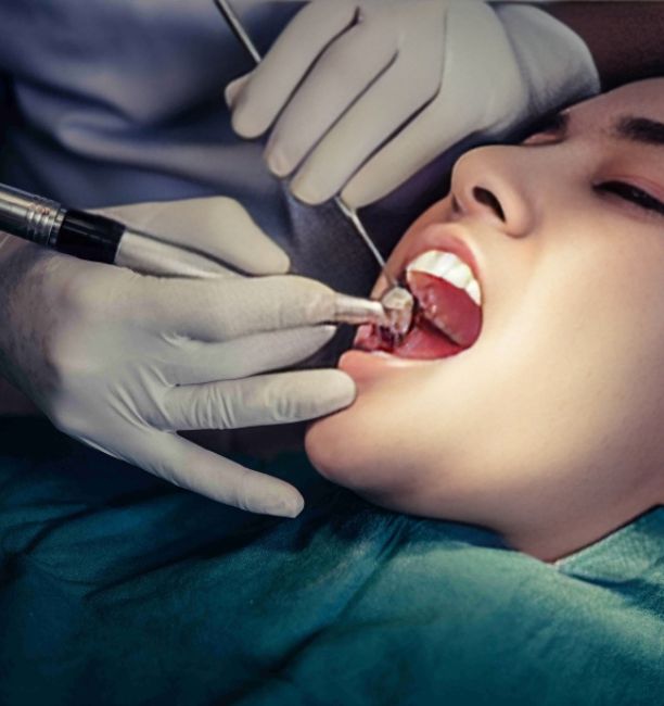 root canal treatment
