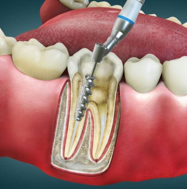 root canal therapy